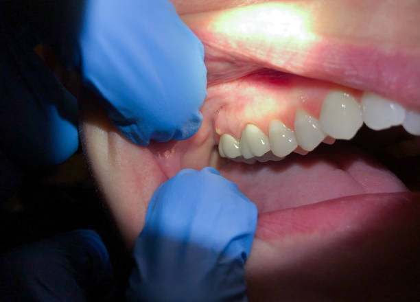 Best Emergency Wisdom Teeth Removal in Chena Ridge, AK